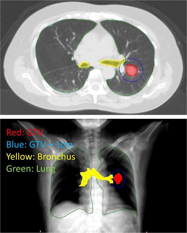 Stereotactic body radiotherapy for central non-small cell lung cancer: risk analysis of radiation pneumonitis and bronchial dose constraints.