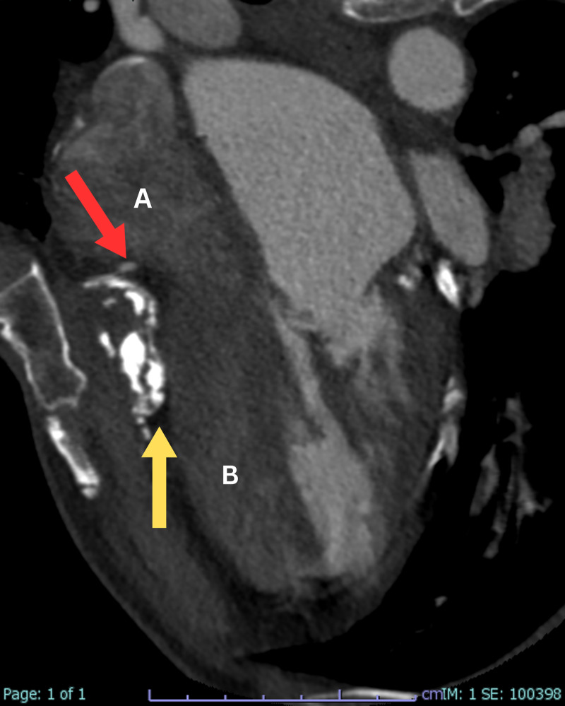 Unveiling Post-Pericardial Resection: <i>Magnificent Imaging of Extensive Residual Pericardial Calcification and Impressive Mitral Valve Thickening</i>.