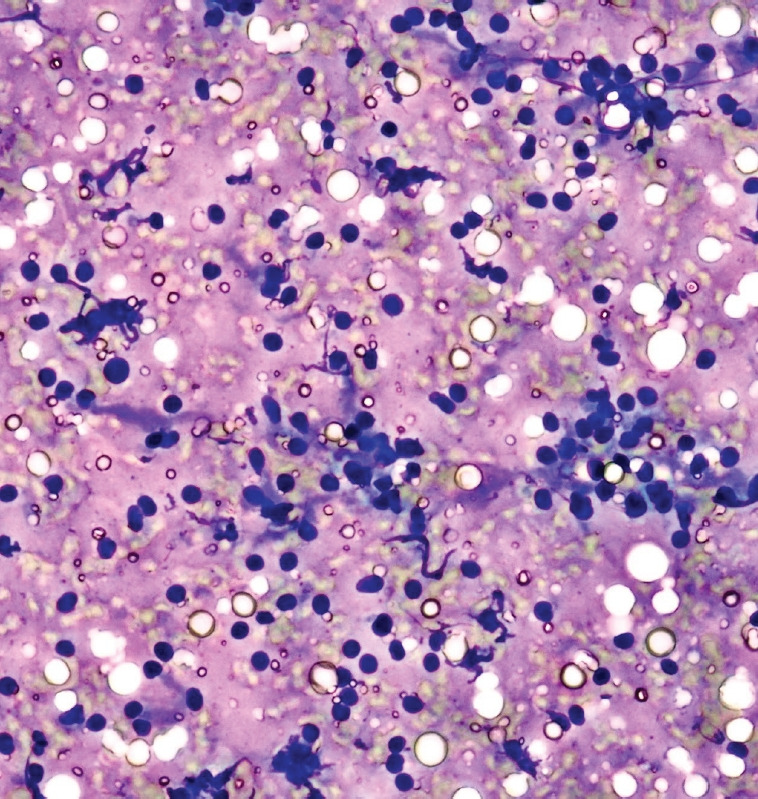 In-room cytologic evaluation by trained endosonographer for determination of procedure end in endoscopic ultrasound-guided fine needle biopsy of solid pancreatic lesions: a prospective study in Taiwan.