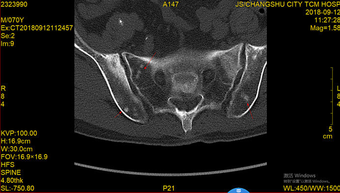 A Case Report of a Patient with Multiple Bone Metastases from Prostate Cancer Achieving Complete Remission for 6 Years after Chemotherapy Combined with Endocrine Therapy.