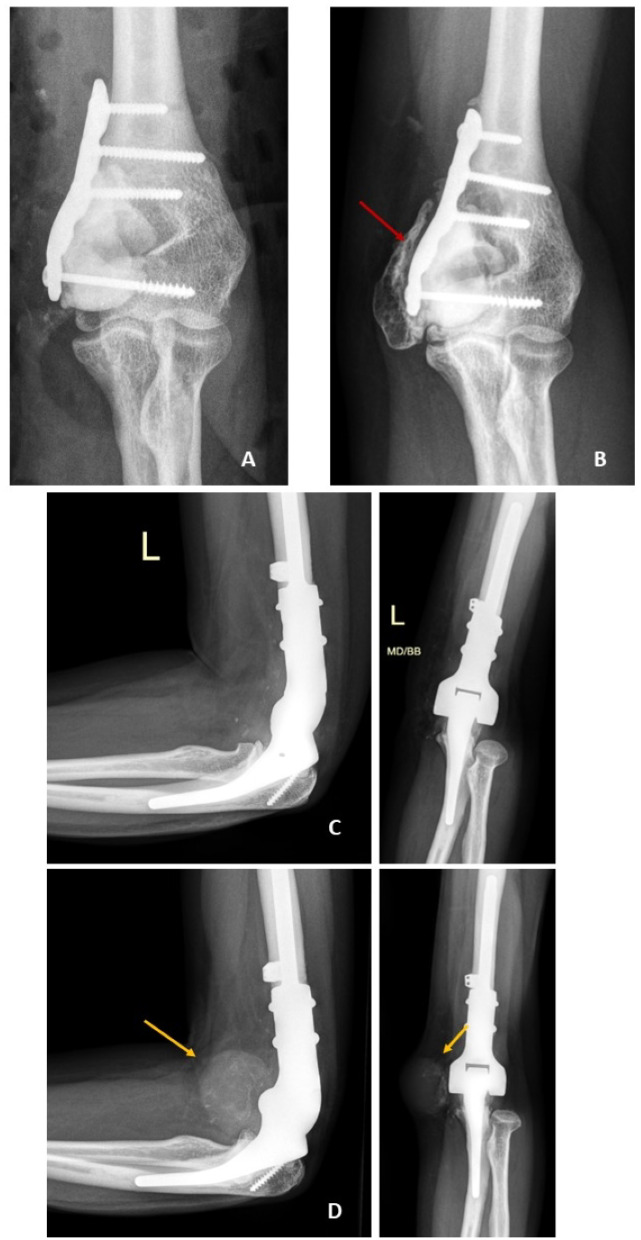 Surgical and radiological outcomes of giant cell tumor of the bone: prognostic value of Campanacci grading and selective use of denosumab.