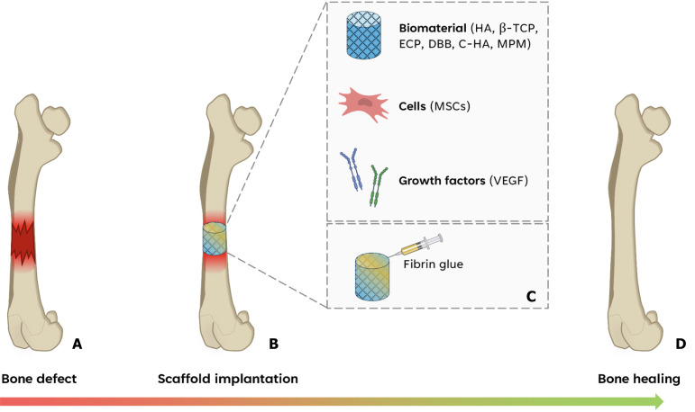 Update on synthetic biomaterials combined with fibrin derivatives for regenerative medicine: Applications in bone defect treatment: Systematic review.