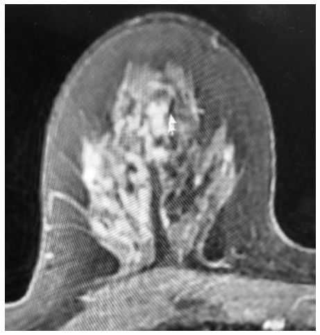 Ductal Carcinoma In Situ: Non-Mass Enhancement on MRI 10 Years Before Mammographic Microcalcifications.