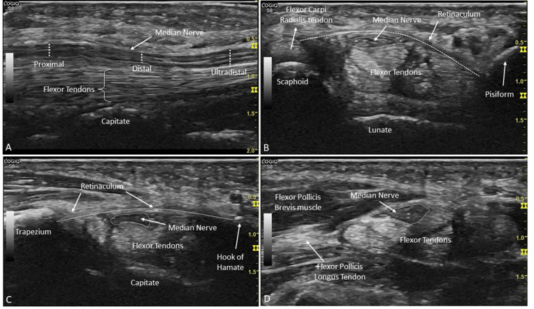 Diagnosis of carpal tunnel syndrome with ultrasound: should we go more distal?