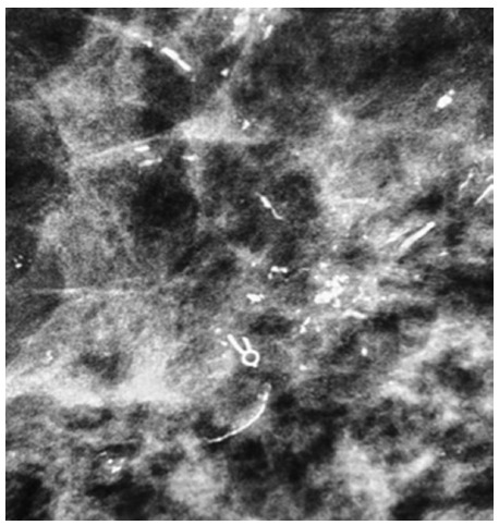 Ductal Carcinoma In Situ: Non-Mass Enhancement on MRI 10 Years Before Mammographic Microcalcifications.