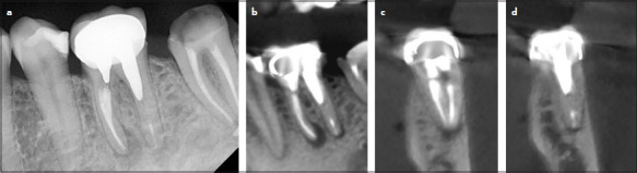 Targeted Endodontic Microsurgery of a Mandibular First Molar with a Separated Instrument Using the 3D-printed Guide and Trephine Bur: A Case Report with a 2-year Follow-up.