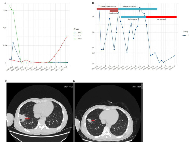 Isavuconazole Successfully Treated Pulmonary Mucormycosis in Acute Myeloid Leukemia: A Case Report.