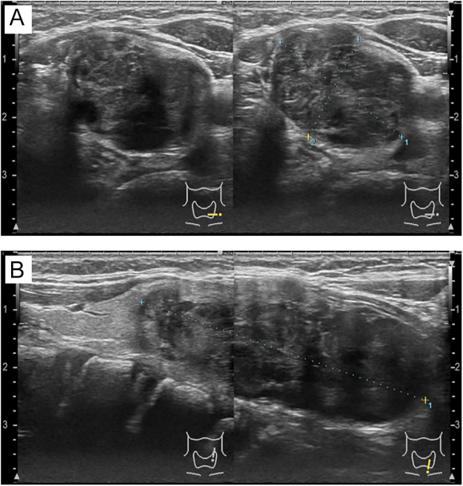 Spindle epithelial tumor with thymus-like elements (SETTLE): a surgical case diagnosed preoperatively using fine-needle aspiration cytology.