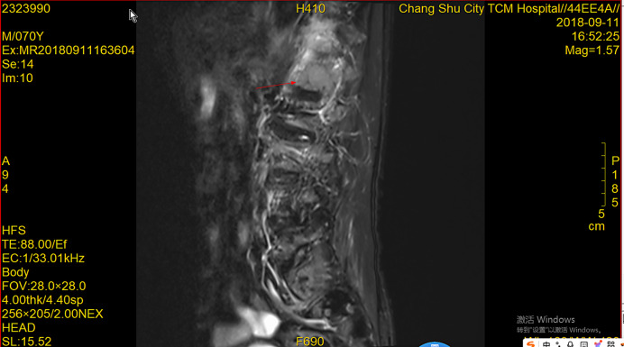 A Case Report of a Patient with Multiple Bone Metastases from Prostate Cancer Achieving Complete Remission for 6 Years after Chemotherapy Combined with Endocrine Therapy.