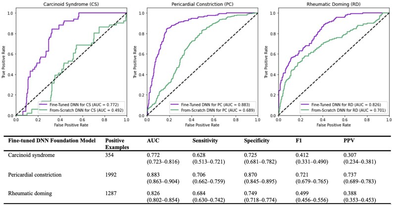A deep foundation model for electrocardiogram interpretation: enabling rare disease detection through transfer learning.