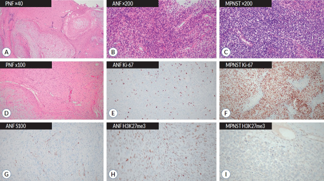 Treatment of Plexiform Neurofibromas : Current Perspectives on Surgery and Medical Treatment.