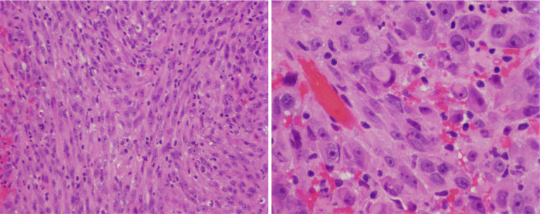 Specific imaging features of sellar atypical teratoid/rhabdoid tumor or the lack of thereof.