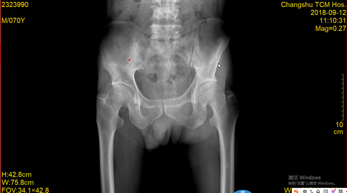 A Case Report of a Patient with Multiple Bone Metastases from Prostate Cancer Achieving Complete Remission for 6 Years after Chemotherapy Combined with Endocrine Therapy.