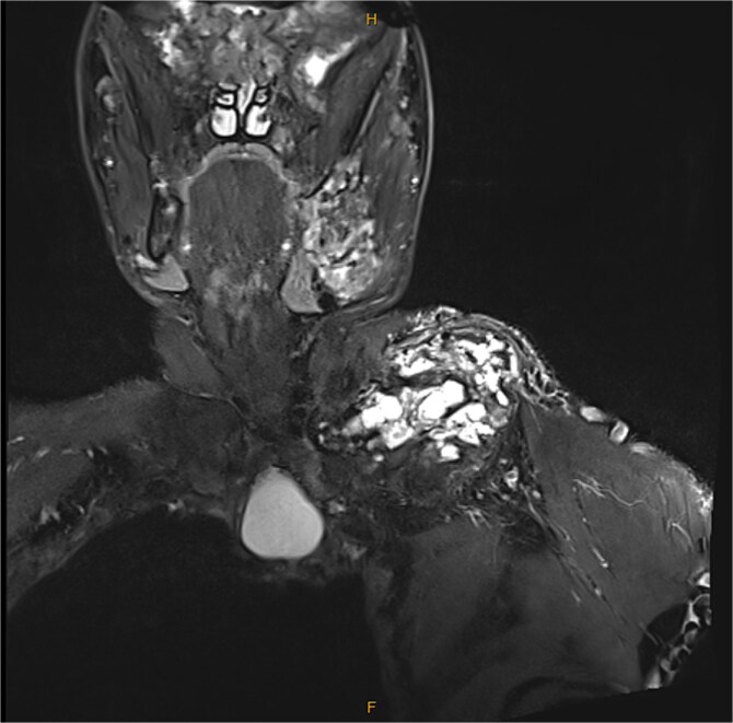 McCune-Albright syndrome: a case of an adult with fibrous dysplasia, severe cardiopulmonary complications, acromegaly, and chronic myeloid leukemia.