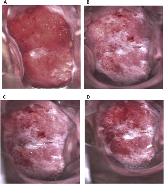 Case Report: Osteoclastic giant cell-rich cervical squamous cell carcinoma-the first reported case of a clinically silent early-detected keratinizing subtype with a detailed literature comparison.