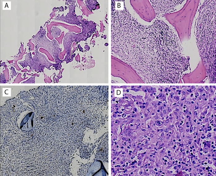 Successful Treatment of Childhood Hodgkin Lymphoma and Secondary Myelofibrosis Resistant to Intensive Therapy, Including Allogeneic Transplantation