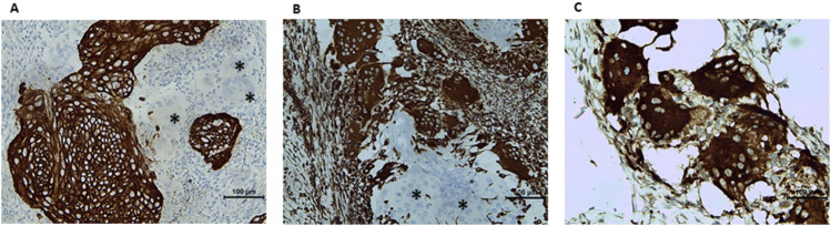 Case Report: Osteoclastic giant cell-rich cervical squamous cell carcinoma-the first reported case of a clinically silent early-detected keratinizing subtype with a detailed literature comparison.