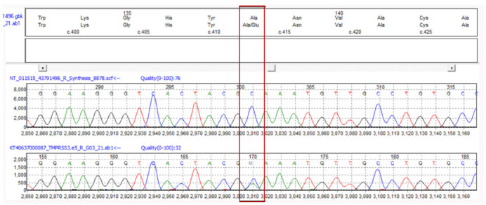 Genetic Rarity: The First Case Report of <i>TMPRSS3</i> Mutation Coinciding with Multicystic Dysplastic Kidney.