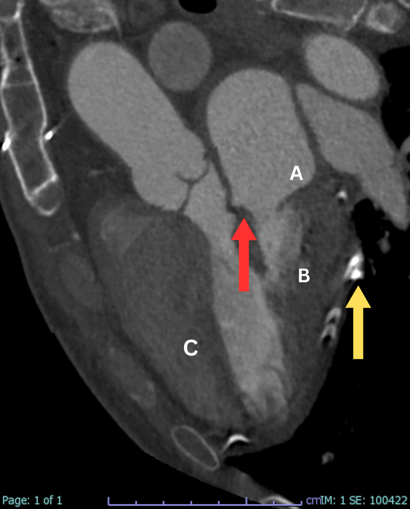 Unveiling Post-Pericardial Resection: <i>Magnificent Imaging of Extensive Residual Pericardial Calcification and Impressive Mitral Valve Thickening</i>.