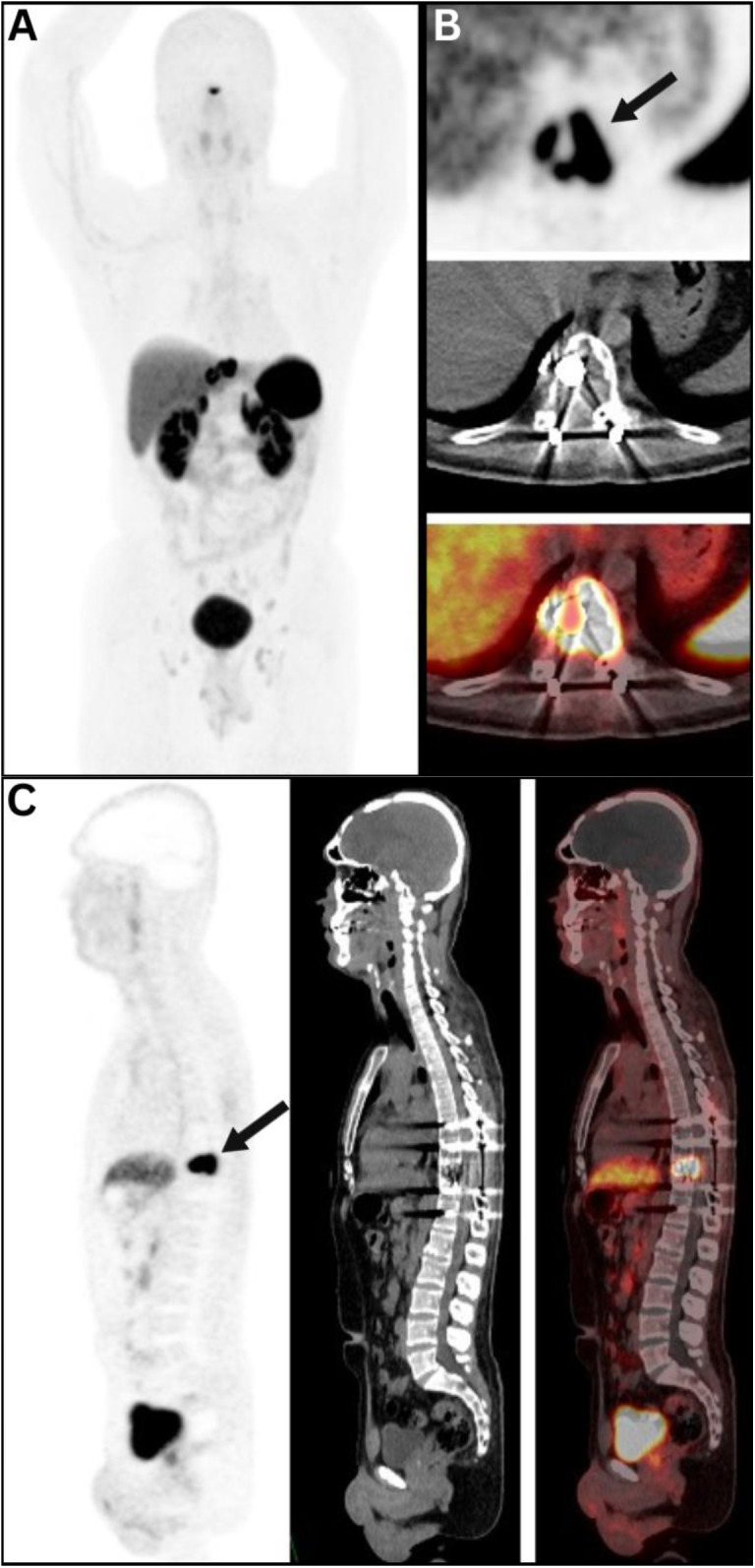 Unveiling Hemangiopericytoma: <i>A case demonstrating the utility of somatostatin receptor-positive metastatic hemangiopericytoma on <sup>68</sup>Ga-DOTA TOC PET/CT</i>.