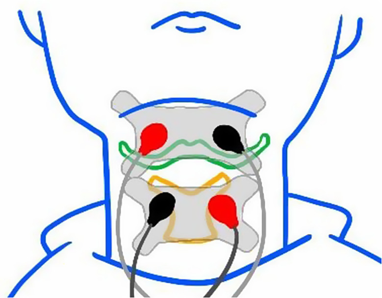 Effects of oral care combined with neuromuscular electrical stimulation on clinical outcomes in the acute phase of acute ischemic stroke: a pilot randomized controlled trial.