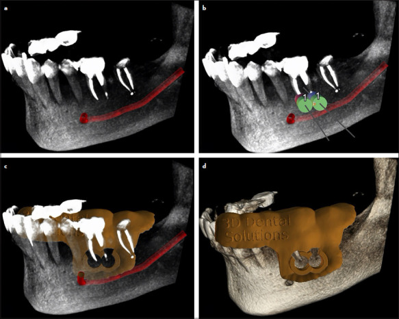 Targeted Endodontic Microsurgery of a Mandibular First Molar with a Separated Instrument Using the 3D-printed Guide and Trephine Bur: A Case Report with a 2-year Follow-up.