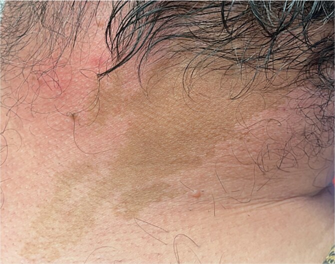 McCune-Albright syndrome: a case of an adult with fibrous dysplasia, severe cardiopulmonary complications, acromegaly, and chronic myeloid leukemia.