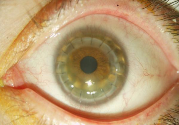 Stapler for corneal transplantation: a hypothesis.