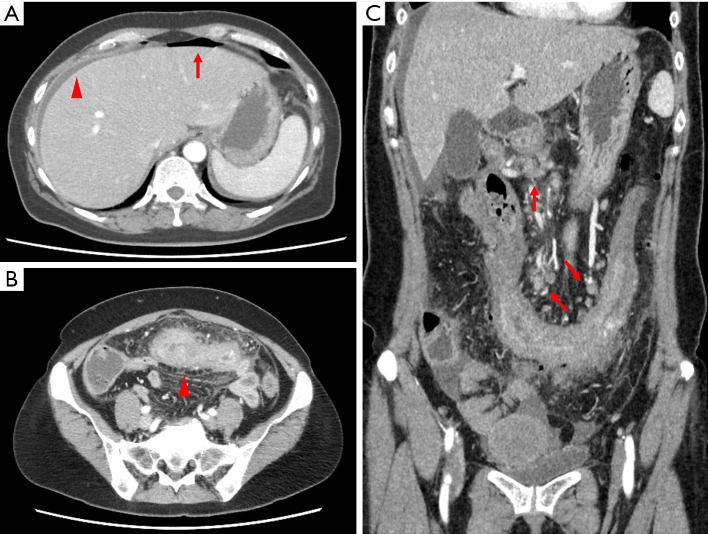 Perforated primary adenocarcinoma of the colon with choriocarcinoma differentiation treated with targeted colorectal cancer chemotherapy: a case report.