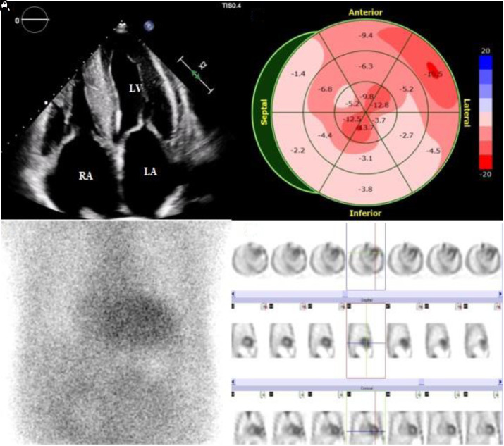 Mutant p.Val114Ala Transthyretin-Related Cardiac Amyloidosis with Heart Failure and Right Bundle Branch Block.