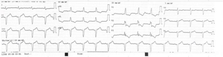 Mutant p.Val114Ala Transthyretin-Related Cardiac Amyloidosis with Heart Failure and Right Bundle Branch Block.