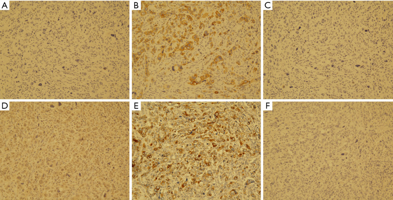 Perforated primary adenocarcinoma of the colon with choriocarcinoma differentiation treated with targeted colorectal cancer chemotherapy: a case report.