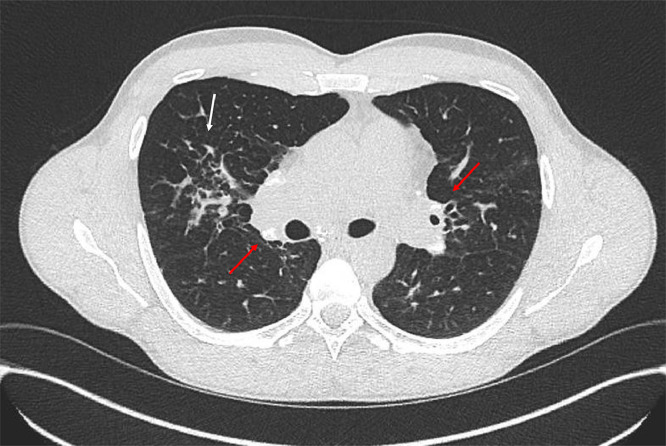 Sarcoidosis: Key disease aspects and update on management.