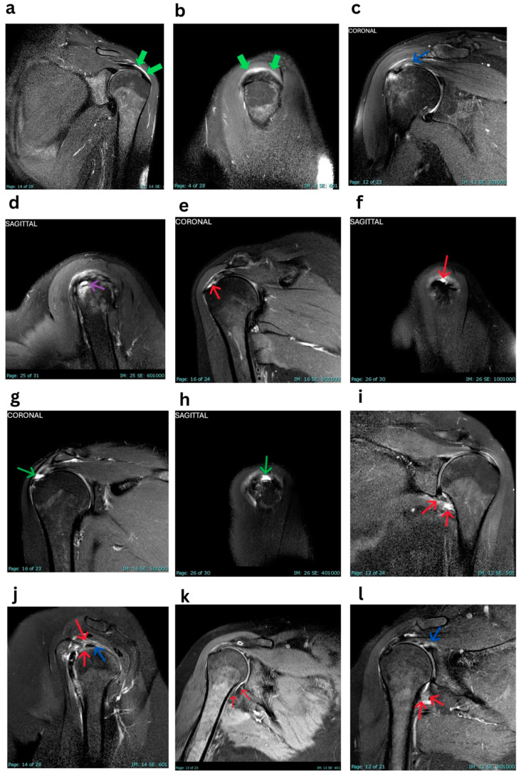Shoulder Injury Related to Vaccine Administration (SIRVA) Following COVID-19 Vaccination: Correlating MRI Findings with Patient Demographics.