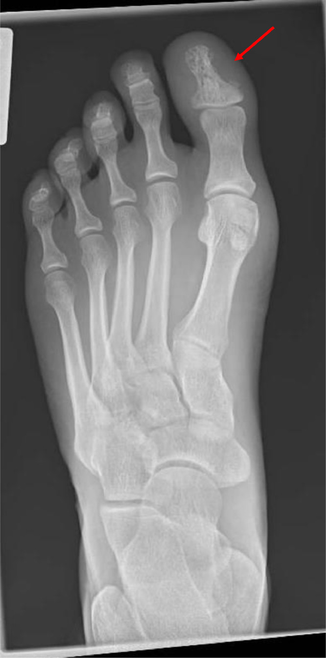 Sarcoidosis: Key disease aspects and update on management.