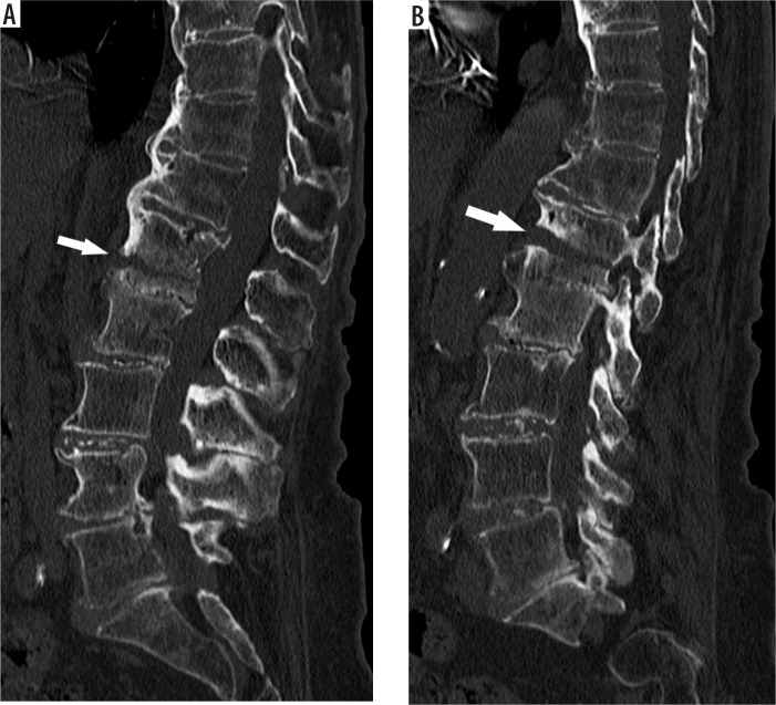 Acute thoracolumbar fractures in patients with a rigid spine: a computed tomography study.