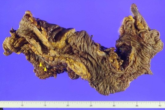 Perforated primary adenocarcinoma of the colon with choriocarcinoma differentiation treated with targeted colorectal cancer chemotherapy: a case report.