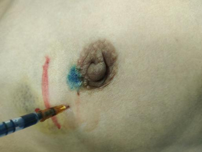 Risk of Residual Axillary Lymph Node Macrometastasis in Early Breast Cancer PATIENTS with One Positive Macrometastasis Sentinel Lymph Node.