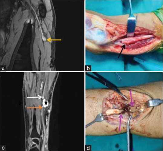 Utility of High-Resolution 3 T MR Neurography in Peripheral Nerve Pathologies.