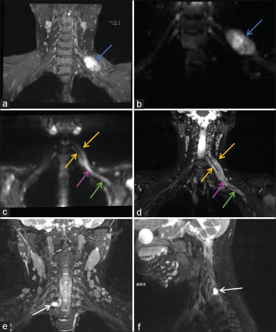 Utility of High-Resolution 3 T MR Neurography in Peripheral Nerve Pathologies.