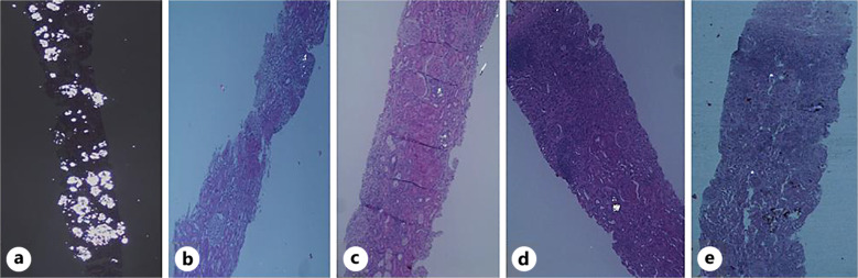 Plasma Glycolate Levels Contribute to Drive the Decision of Isolated Kidney Transplantation in Dialyzed Patients with End-Stage Kidney Disease due to Primary Hyperoxaluria Type 1 Treated with Lumasiran: A Case Report.