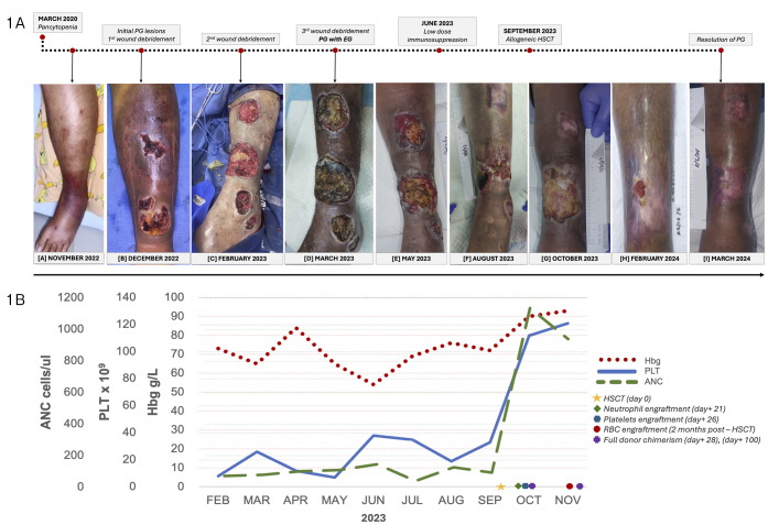 PYODERMA GANGRENOSUM WITH NON-PSEUDOMONAL ECTHYMA GANGRENOSUM IN MYELODYSPLASTIC SYNDROME TREATED WITH ALLOGENEIC HEMATOPOIETIC STEM CELL TRANSPLANTATION.