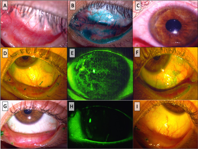 Childhood-onset ocular mucous membrane pemphigoid presenting with peripheral ulcerative keratitis: a case report and review of the literature.