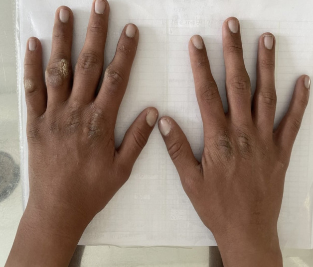 Pachydermodactily - the great imitator of arthritis: a case series.