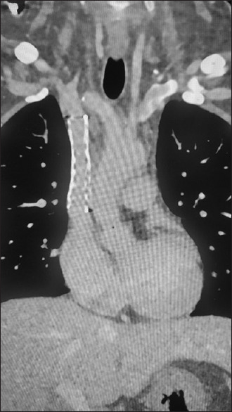 Histoplasmosis presenting as fibrosing mediastinitis and superior vena cava obstruction.