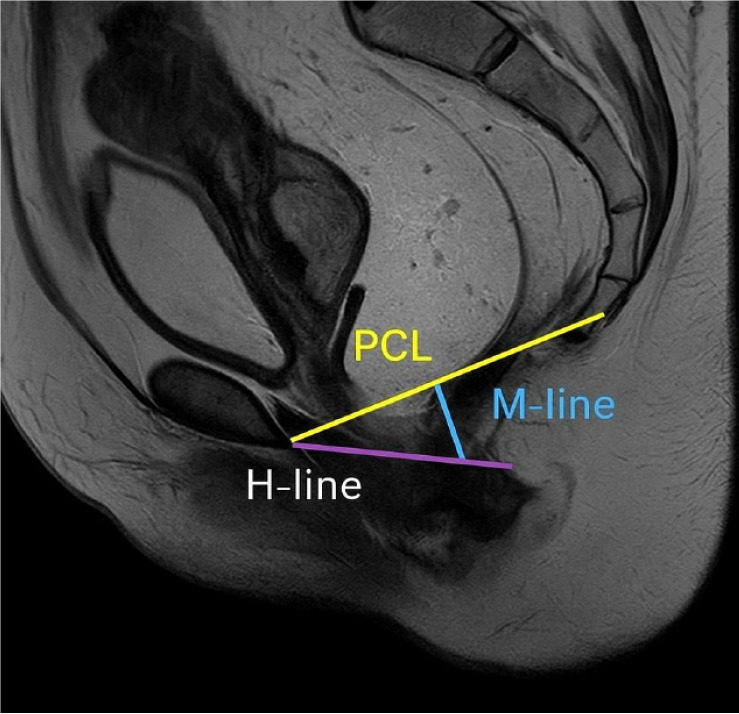 Magnetic resonance defecography assessment of obstructed defecation syndrome in patients with chronic constipation in a tertiary care hospital.