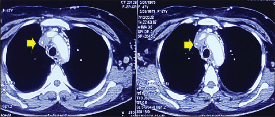 Histoplasmosis presenting as fibrosing mediastinitis and superior vena cava obstruction.