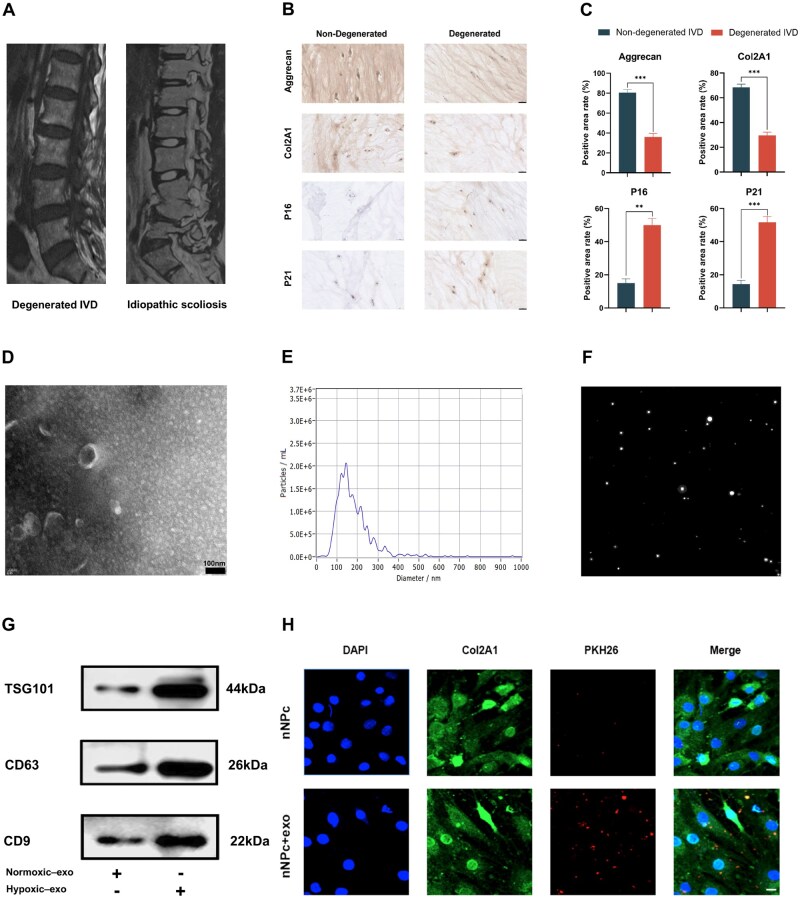 Injectable hydrogel loaded with exosomes from hypoxic umbilical cord-derived mesenchymal stem cells alleviates intervertebral disc degeneration by reversing nucleus pulposus cell senescence.