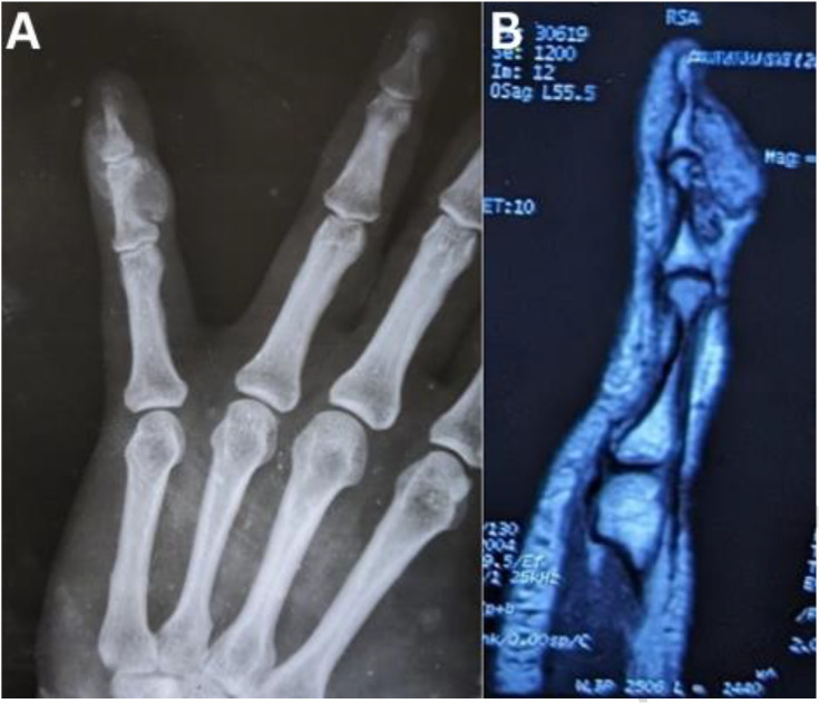 Chondromyxoid Fibroma of Phalanges.