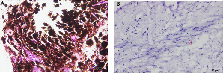 A case report: iridociliary melanocytoma associated with secondary glaucoma.
